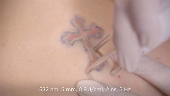 Tattoo Treatment Video