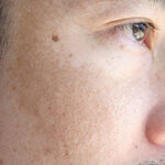 Close up Asian man face with freckles dark spots from uv light