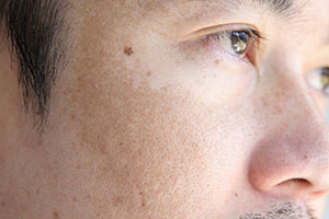Close up Asian man face with freckles dark spots from uv light